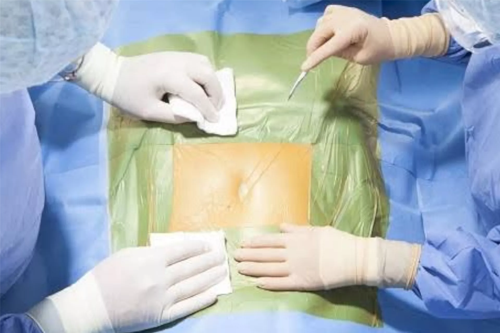 Surgical Incision Film Drep
