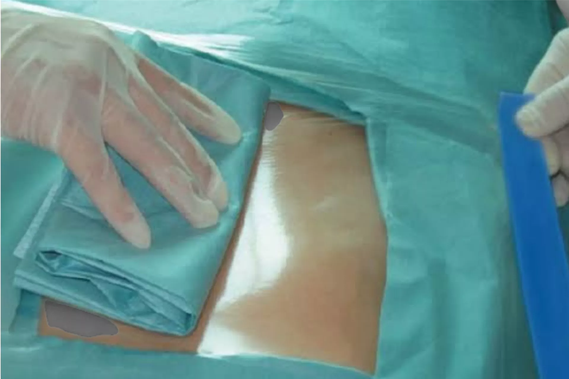 Surgical Incision Film Drep